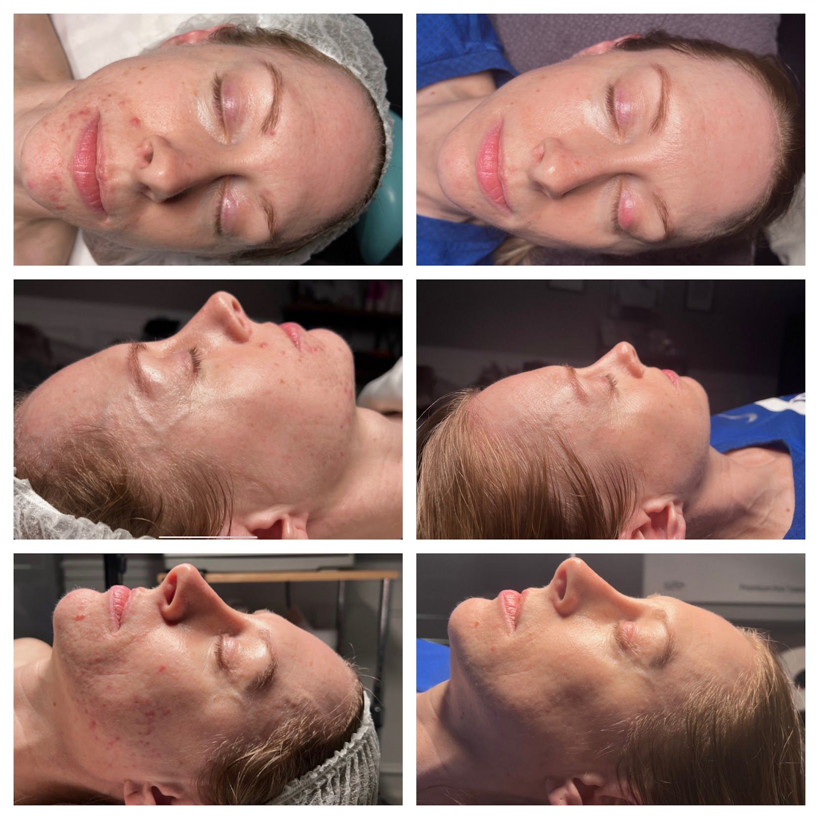 Side-by-side face profiles before and after a cosmetic treatment, with visible skin texture improvement