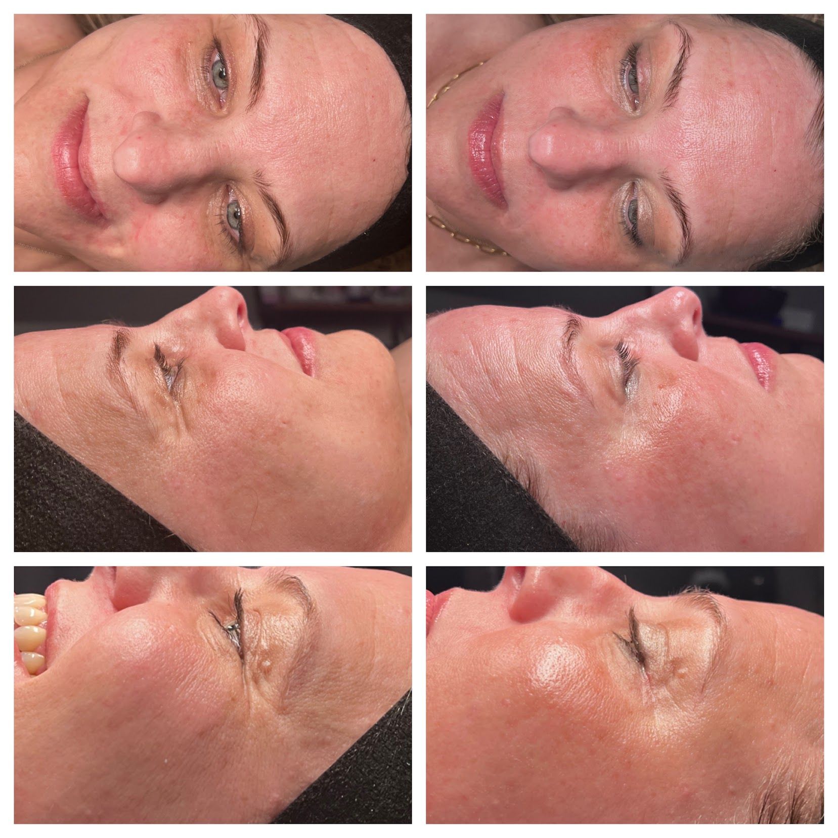 Collage of six close-up facial profile photos showing a person’s skin before and after treatment.