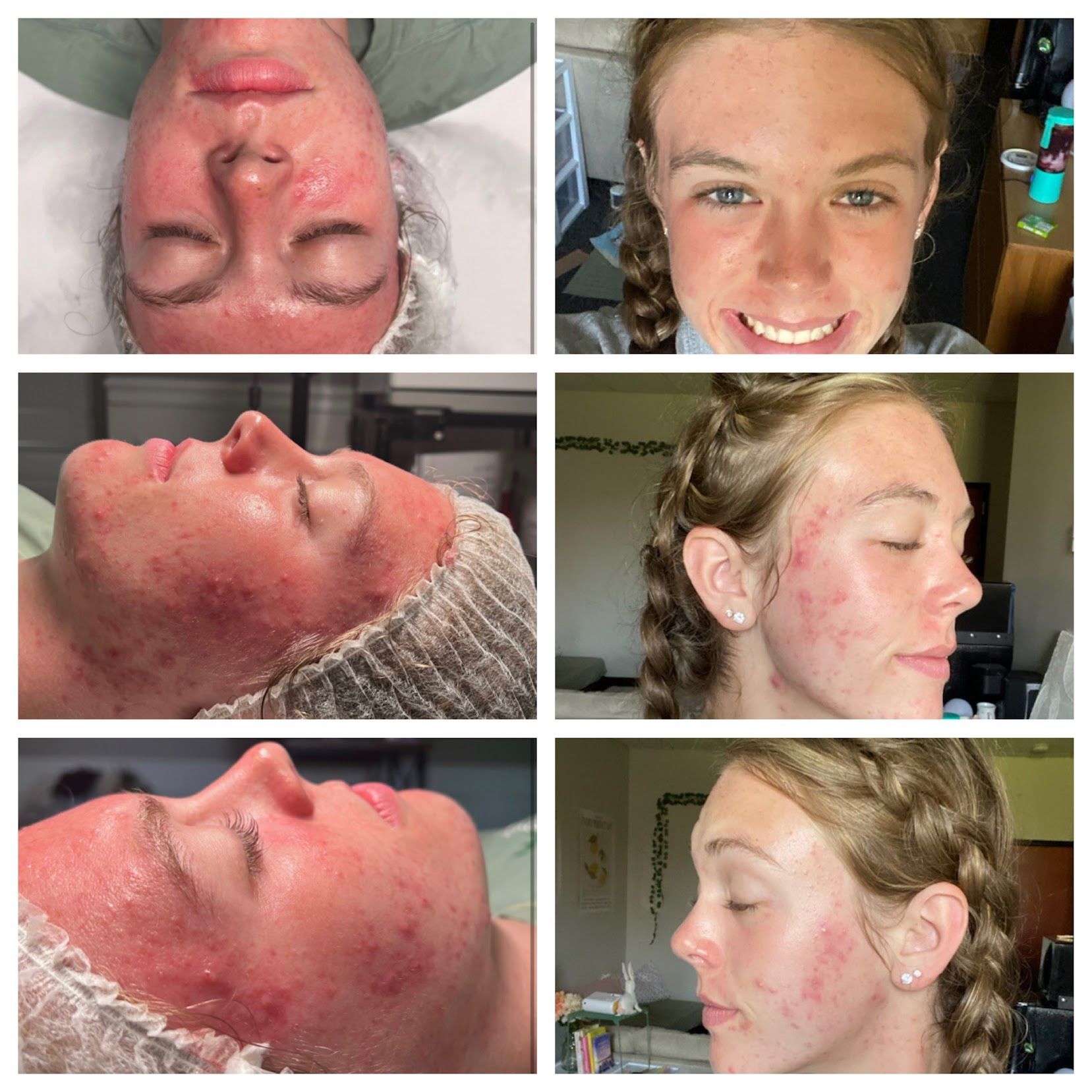 Collage of a woman’s face showing severe red, irritated skin before and after treatment