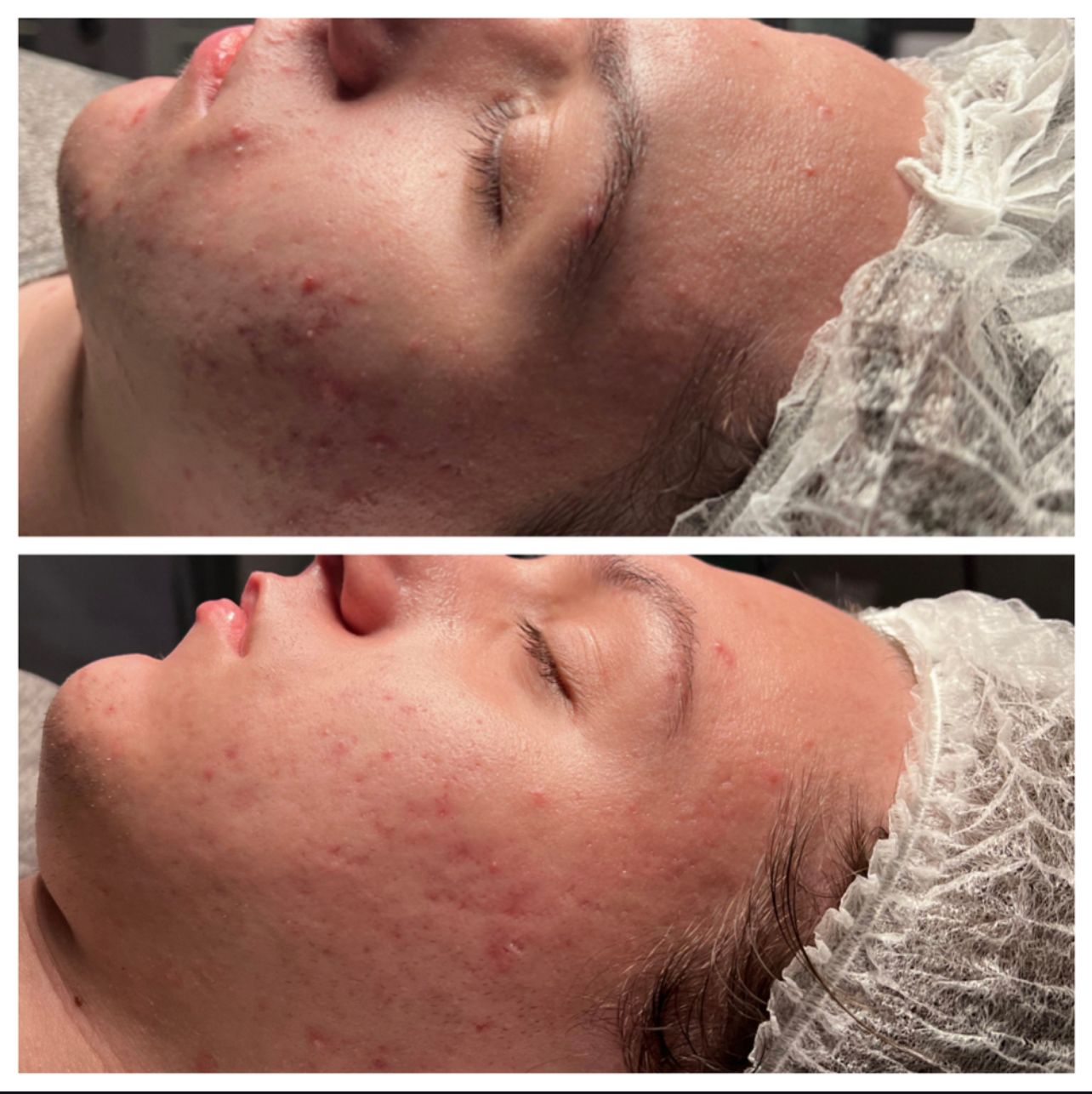Side-by-side profile close-ups of a face with acne before and after treatment at a clinic