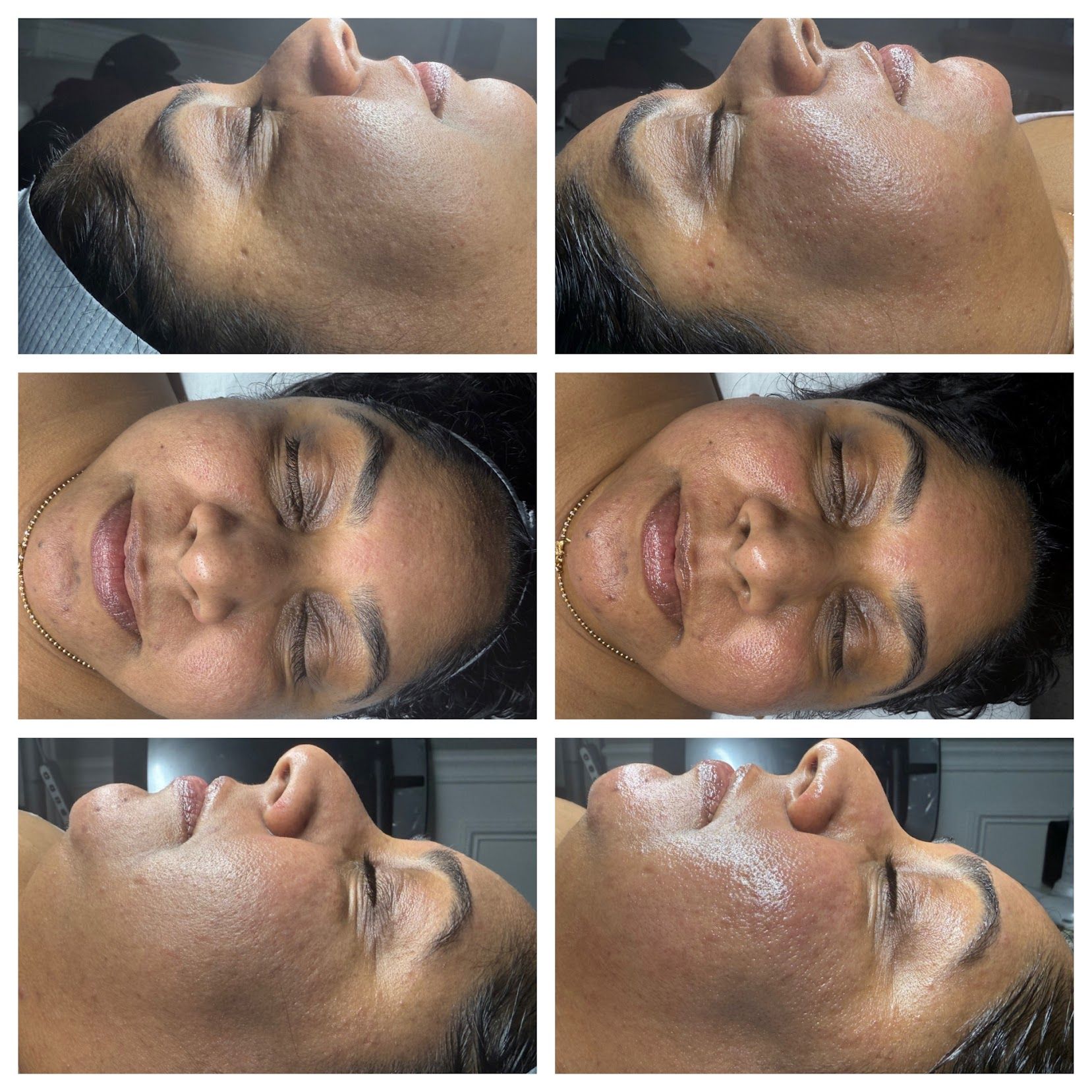 Six-panel close-up of a person’s face, showing wet skin in side and front views.