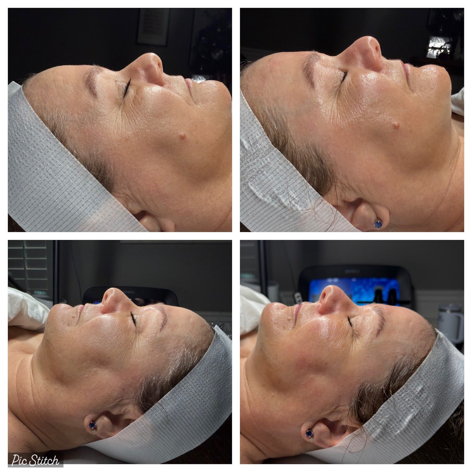 Four-panel close-up of a face with skincare treatment at a salon, showing before-and-after results.
