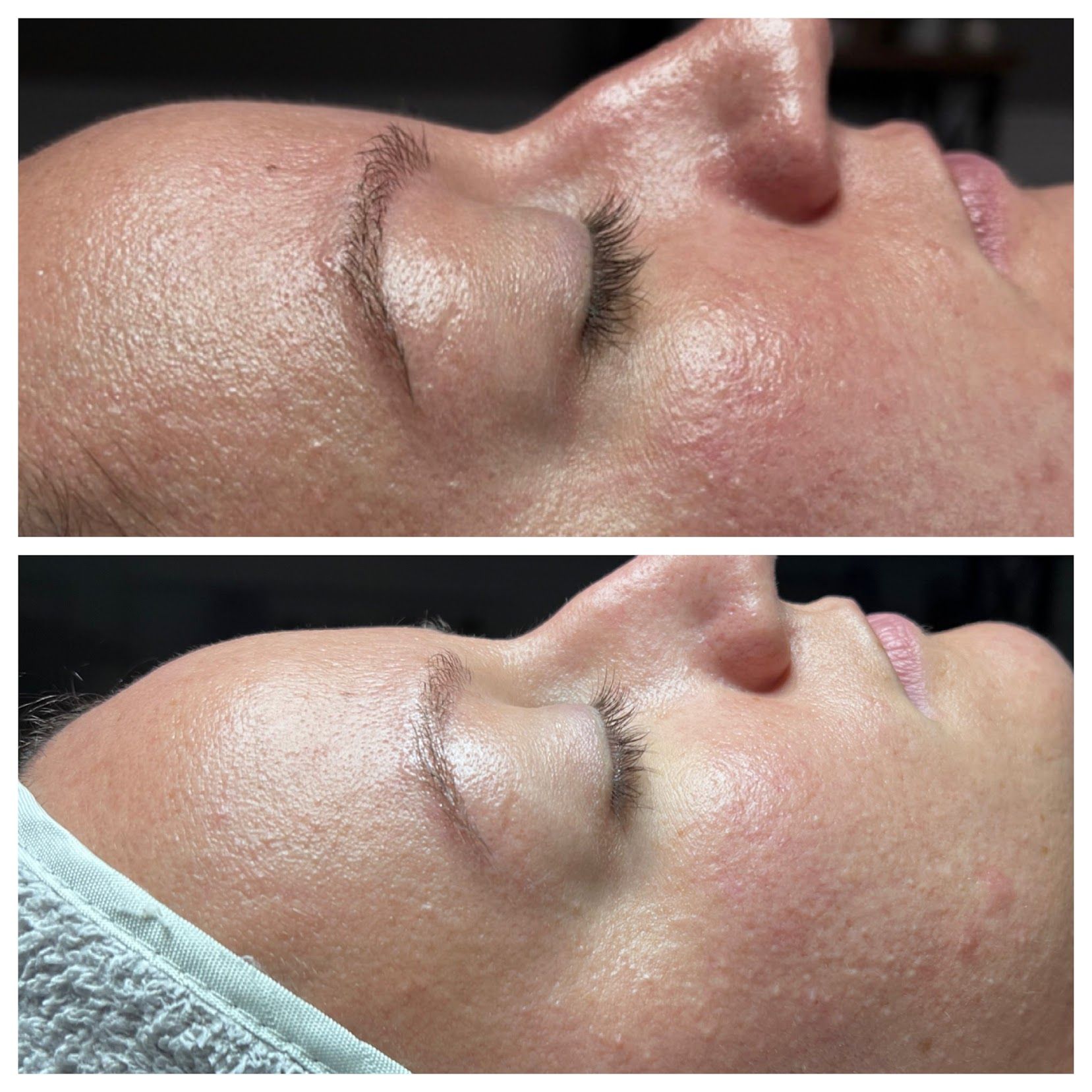 Side-by-side close-ups of a person’s face before and after a skin treatment, showing smoother skin.