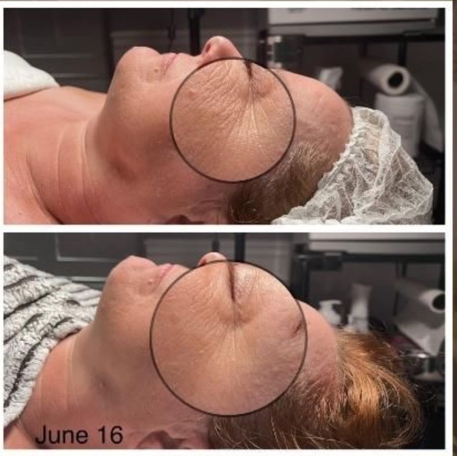 Two side-by-side profile photos show a close-up face with a circled forehead; bottom image labeled June 16.