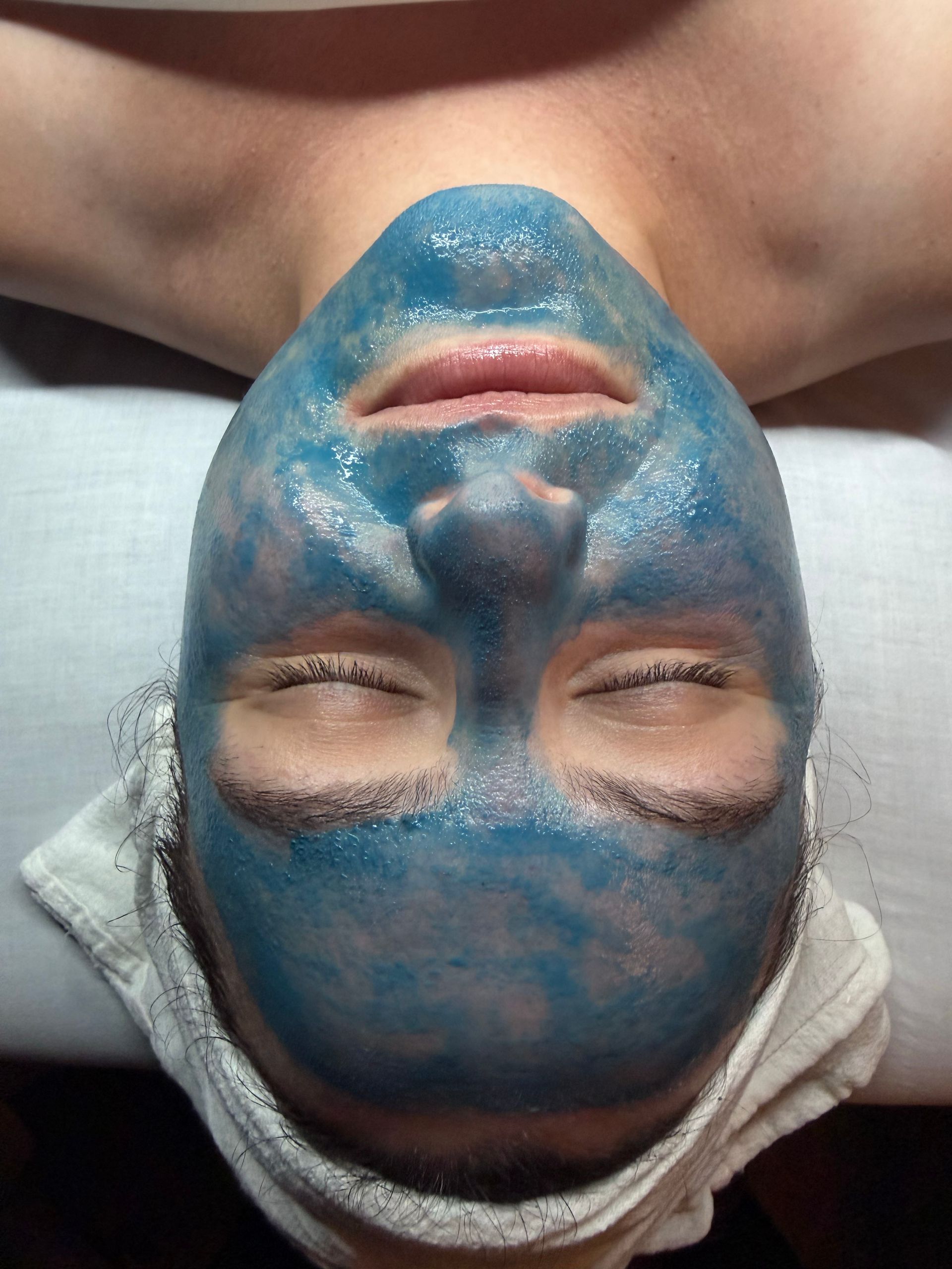 Korean Blue Spicule liquid microneedling treatment at Hans Esthetics in Plainfield, IL