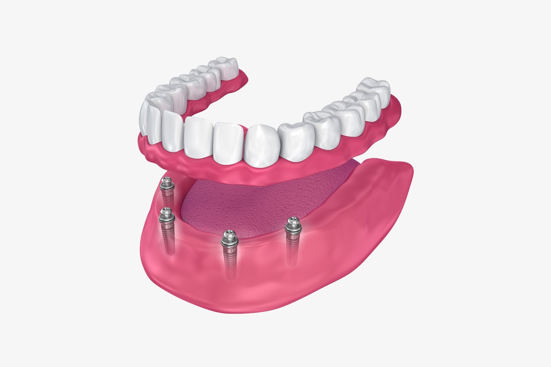 A computer generated image of a full denture with dental implants.