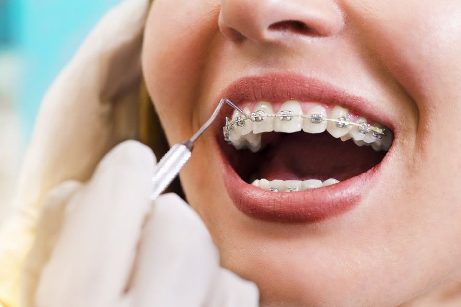Dentista a lavoro su apparecchio di correzione dentale