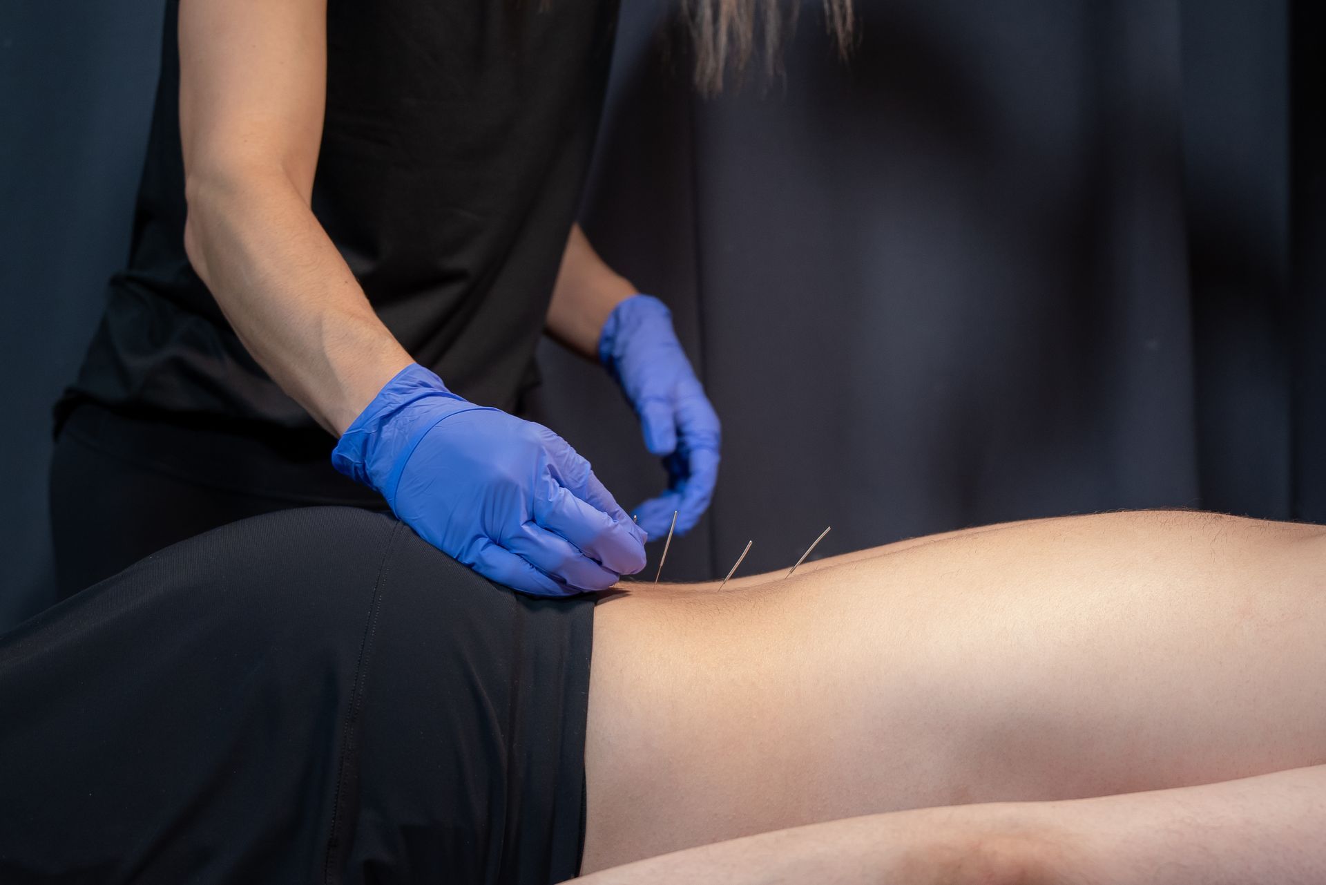 dry needling of the lower back muscles
