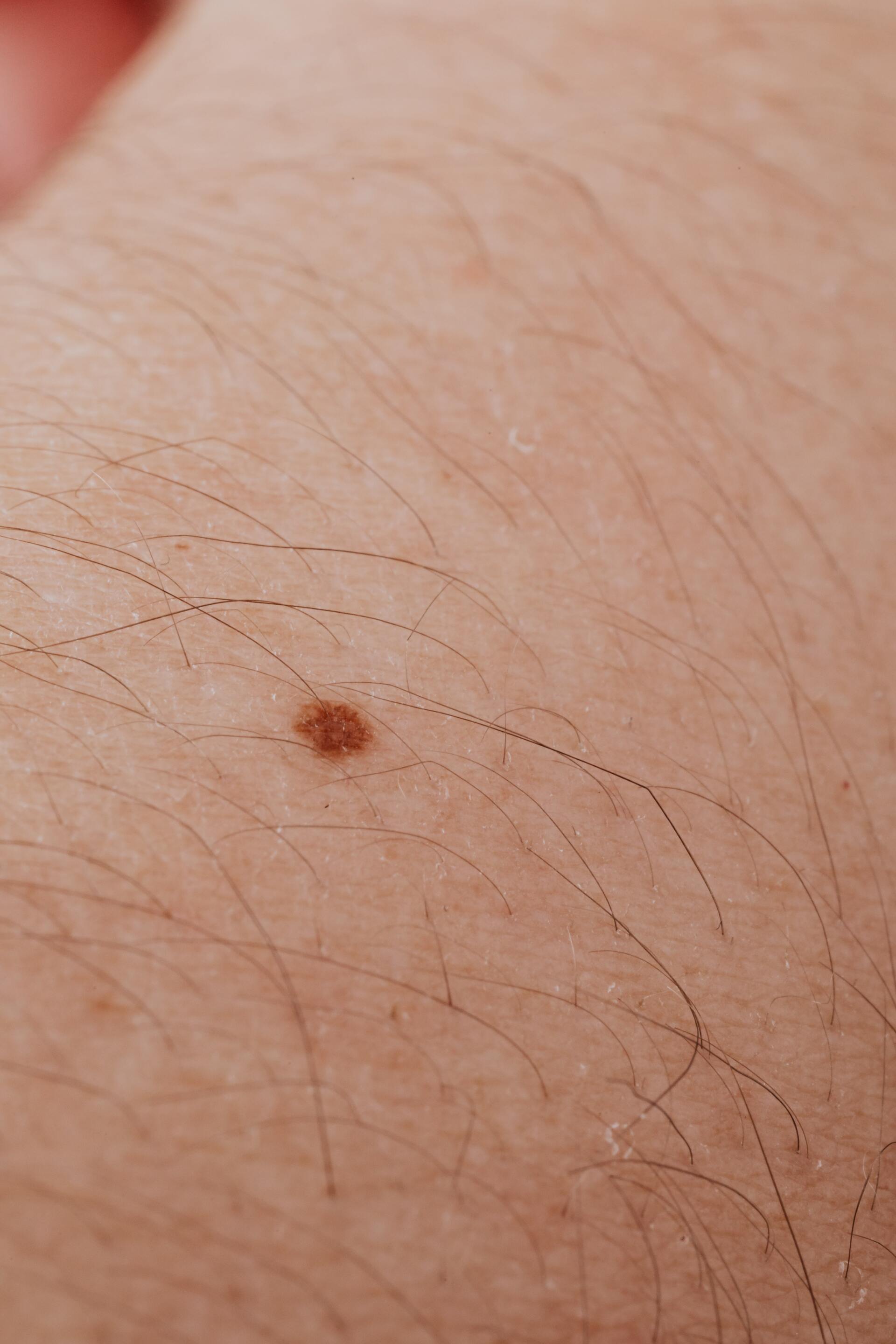 Dermatology