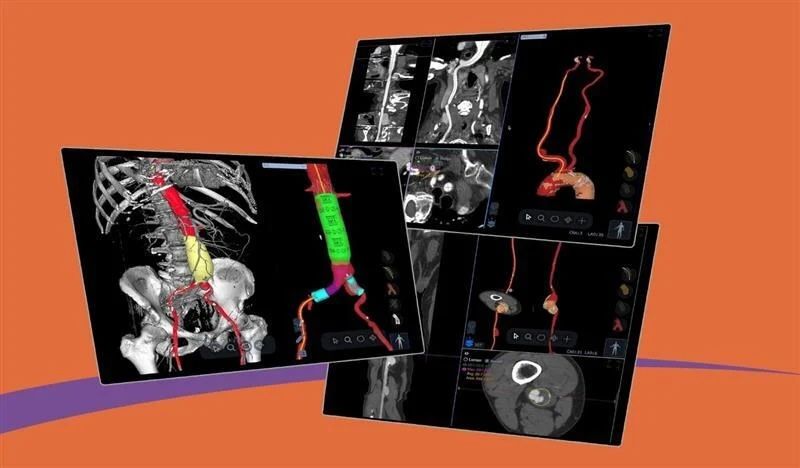 Circle Cardiovascular Imaging Expands cvi42 Platform with Advanced ...