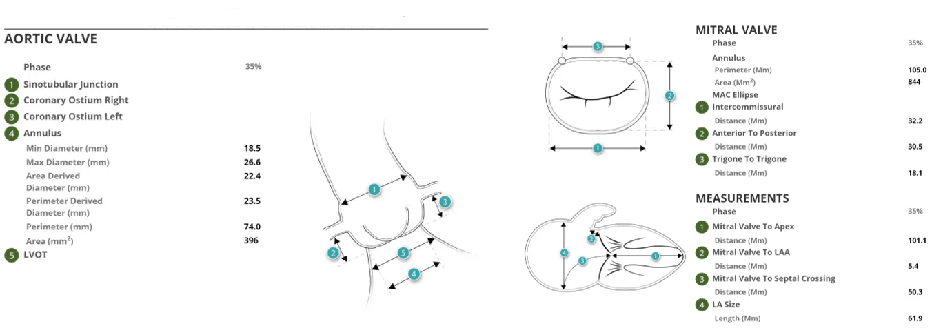 Diagram of aortic valve with measurements and anatomical features labeled.
