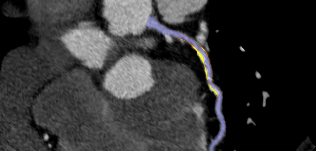 AI Coronary Plaque Analysis: Reimbursement, Risk Stratification