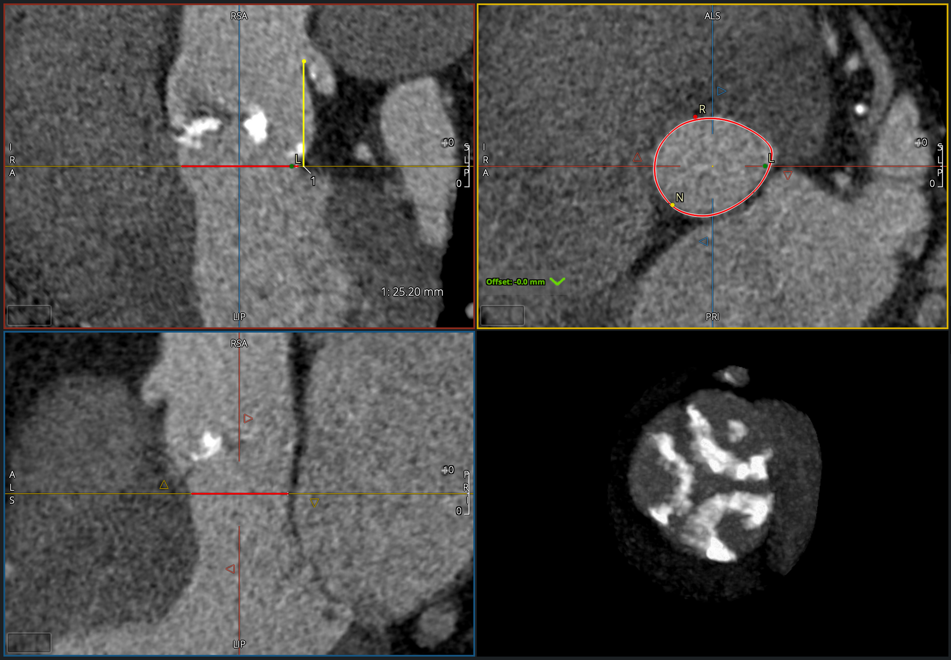 Four-panel CT scan with red crosshairs and a circled lesion in the upper-right panel