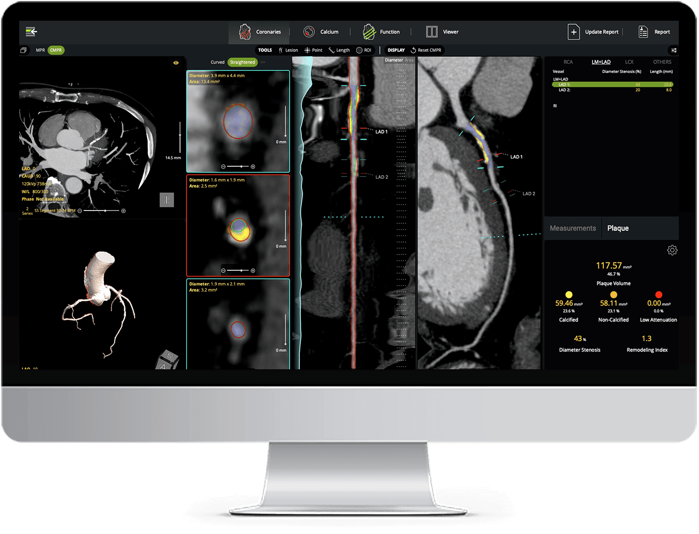 Computer screen displaying medical imaging of a heart, showing various views and analyses of internal structures.