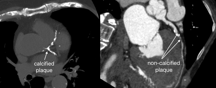 Two CT scan cross-sections showing calcified and non-calcified plaque buildup in human coronary arteries.