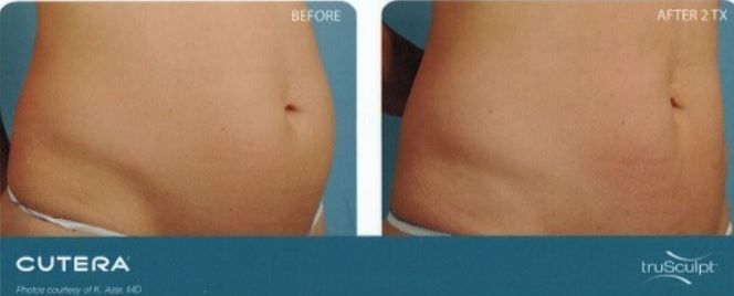 A before and after picture of a woman 's stomach