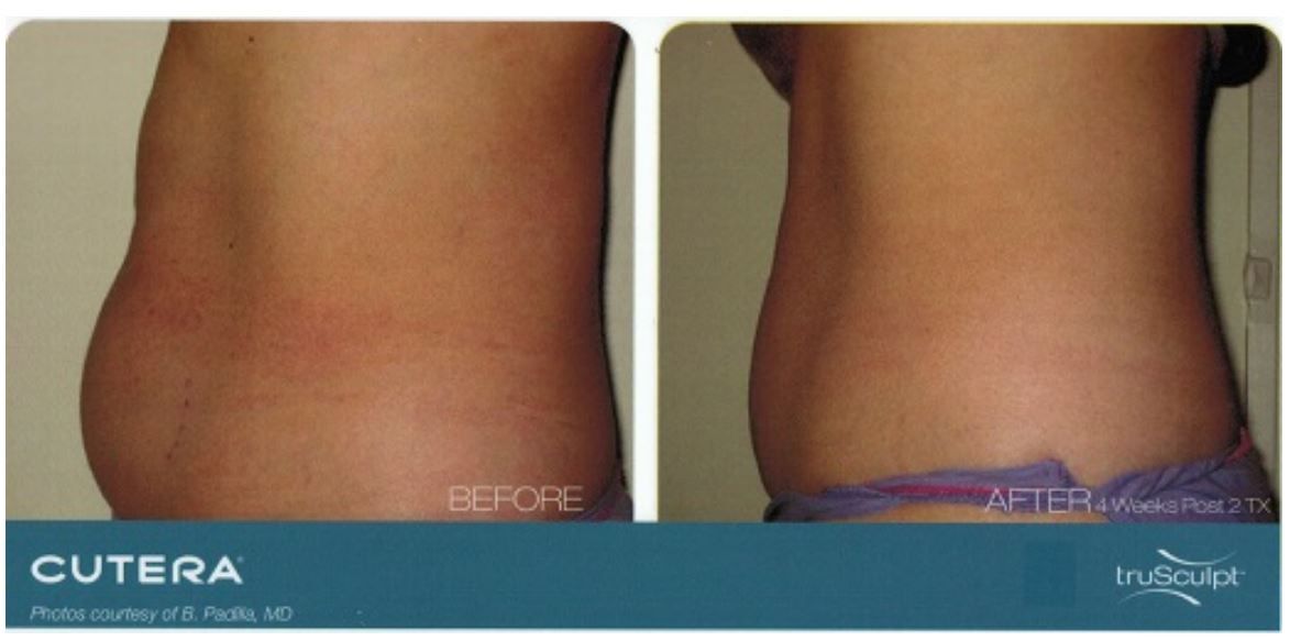 A before and after picture of a woman 's stomach with cutera written on the bottom