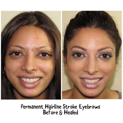 A before and after photo of permanent hairline stroke eyebrows