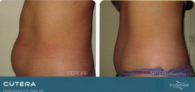 A before and after photo of a woman 's stomach
