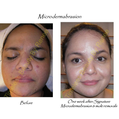 A woman 's face before and after microdermabrasion