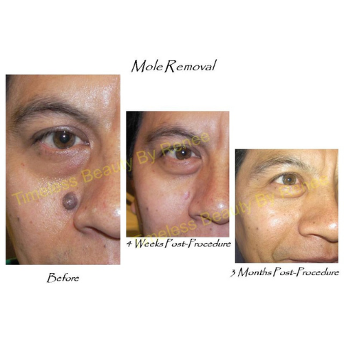 A before and after picture of a mole removal procedure