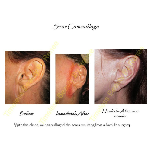 A picture of a woman 's ear before and after scar camouflage