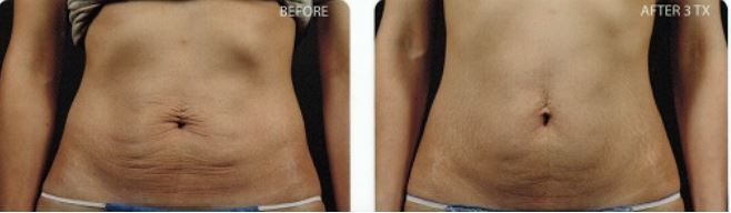 A before and after picture of a woman 's stomach