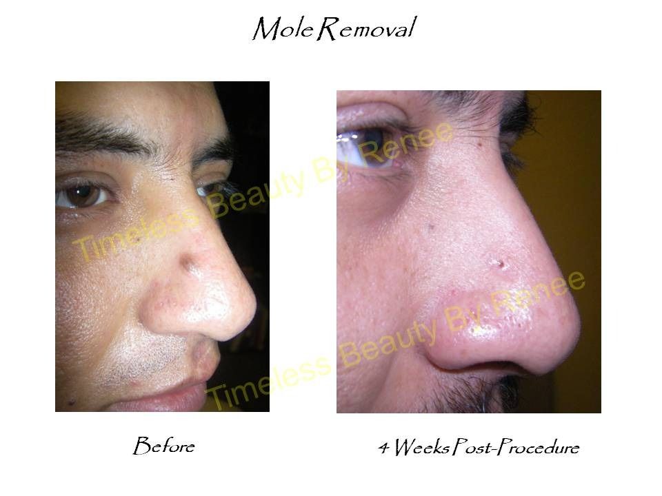 A picture of a man 's nose before and after mole removal