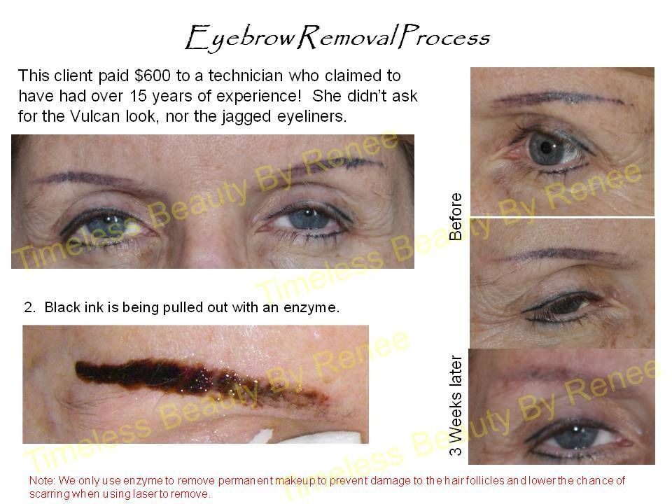 A before and after picture of an eyebrow removal process