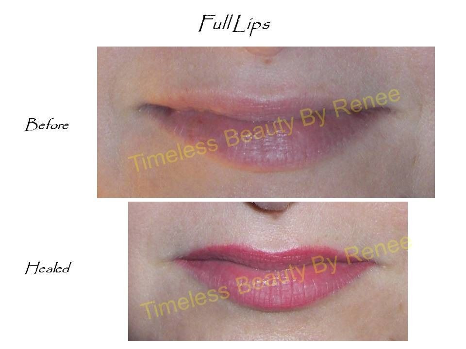 A before and after photo of a woman 's lips by timeless beauty by renee