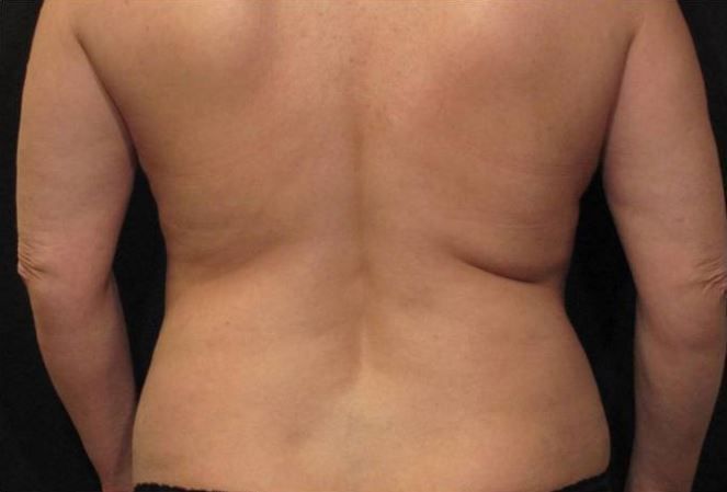 A woman 's back is shown with a black background.