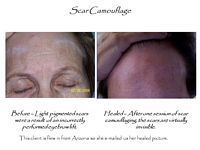 A before and after picture of a woman 's face with scar camouflage.