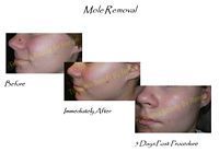 A woman 's face before and after a mole removal procedure.