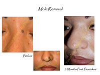A woman 's face before and after a mole removal procedure.
