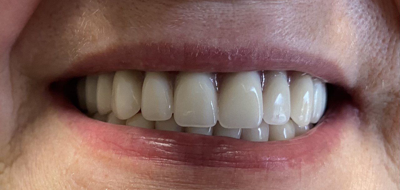 Dental Procedures Cornelia, GA Elite Dentistry of Habersham