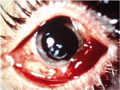 Contact Lens Wearers Need Extra Care 