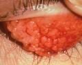 A close up of a person 's eye with red spots on it.