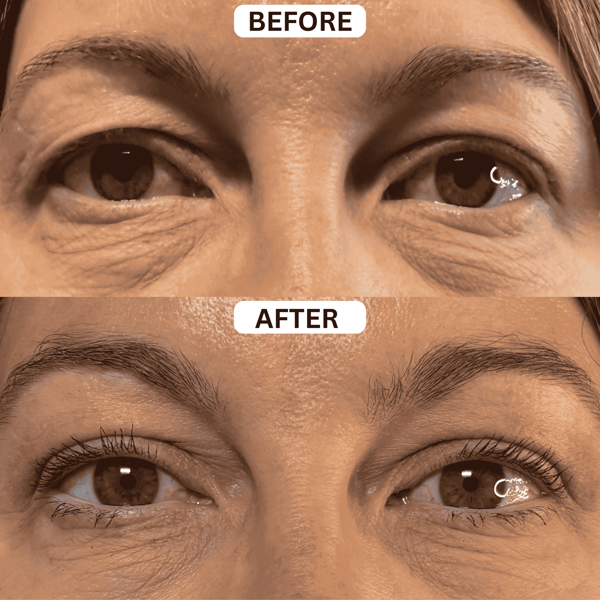 Before-and-after close-up of eyes, showing reduced under-eye wrinkles and smoother skin.