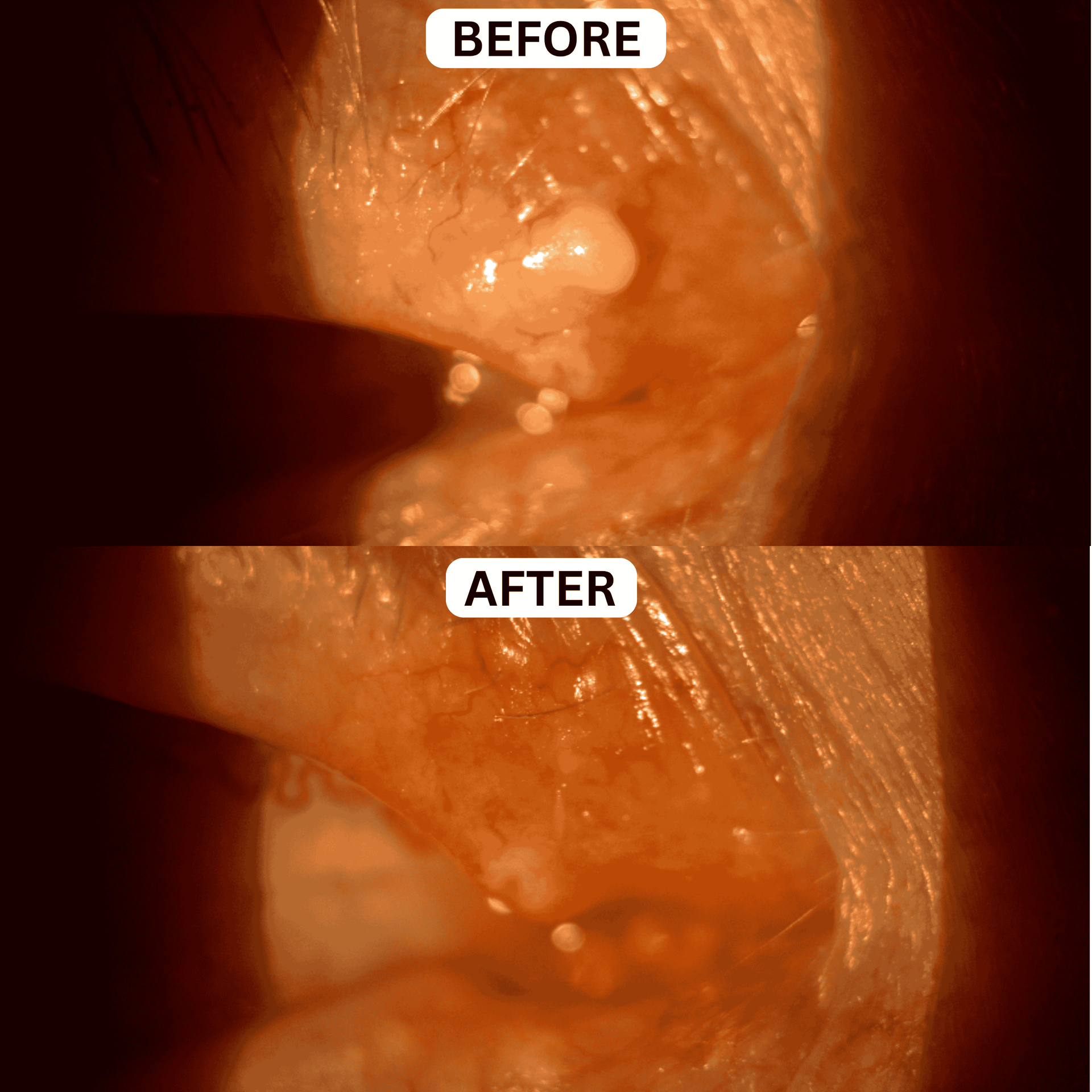 Before-and-after close-up of an orange-brown tissue area with a small raised spot, labeled “BEFORE” and “AFTER”.