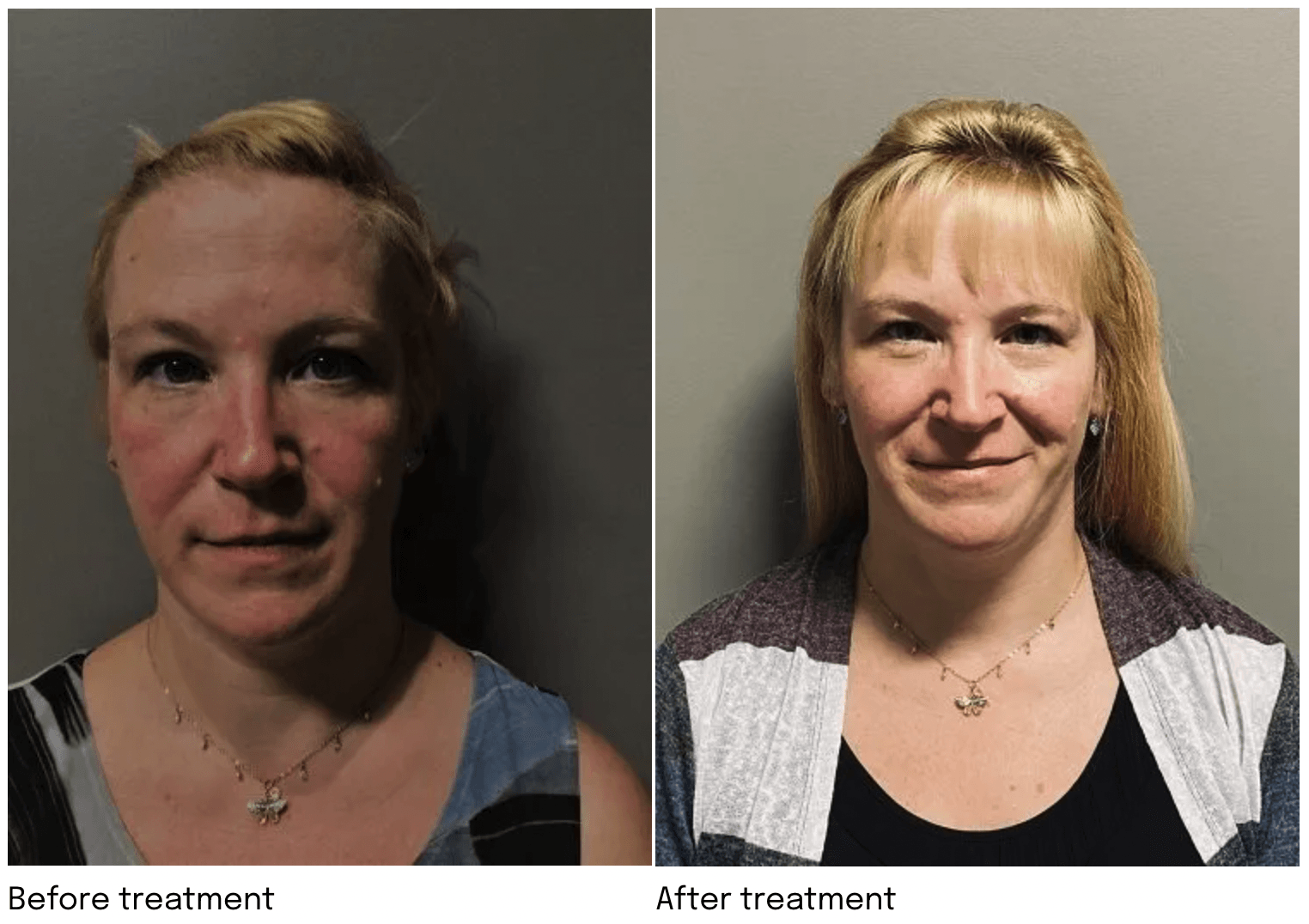 A before and after photo of a woman 's face.