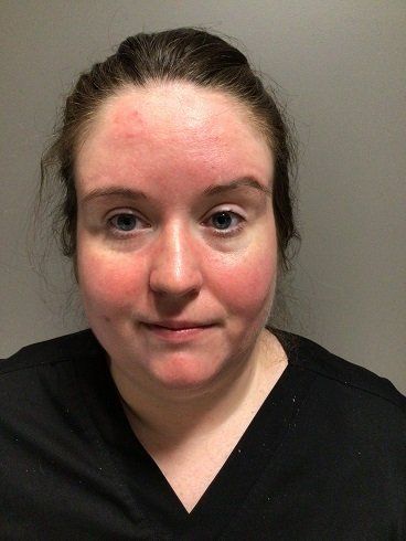 After dry eye treatment showing improved eyelid clarity and reduced inflammation