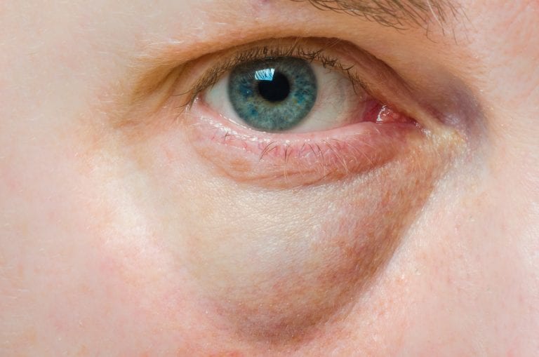 A close up of a man 's eye with a red eye.