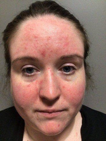 Before dry eye treatment showing visible eyelid inflammation and irritation