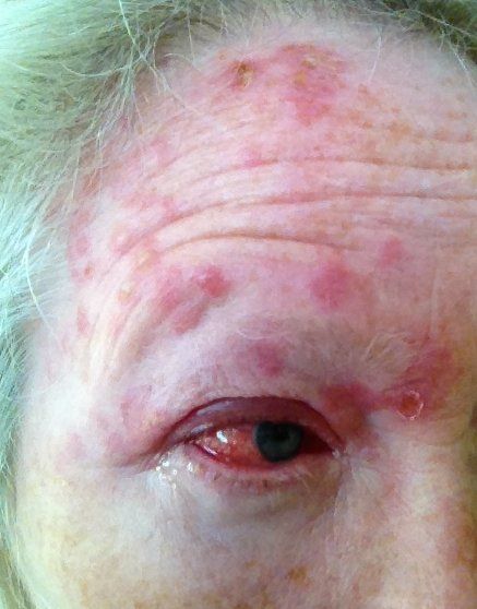 A close up of an elderly woman 's eye and forehead.