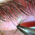 A close up of a person 's eye with a pair of tweezers.