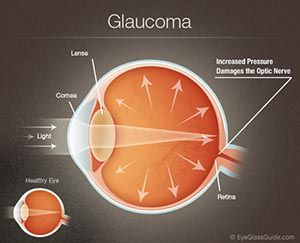 A diagram of a healthy eye and a glaucoma eye