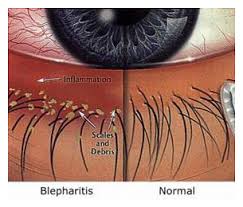 A diagram of a blepharitis and a normal eye.