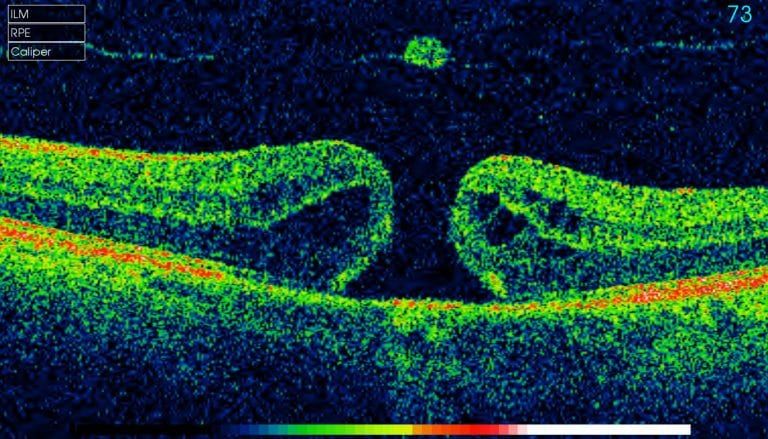 A computer generated image of a person 's eye with the number 73 on it.
