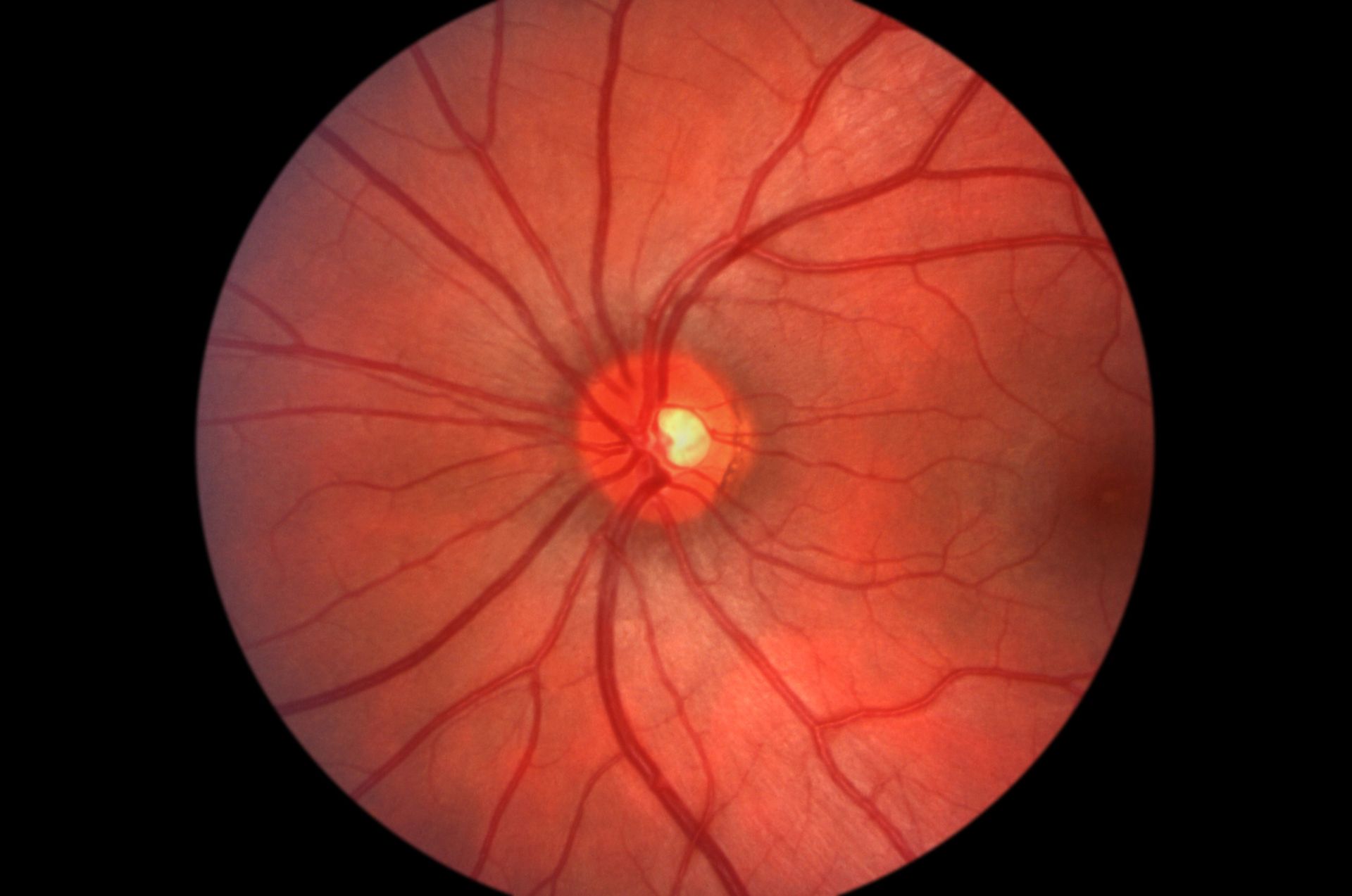 A close up of a person 's eye with a yellow spot in the middle.