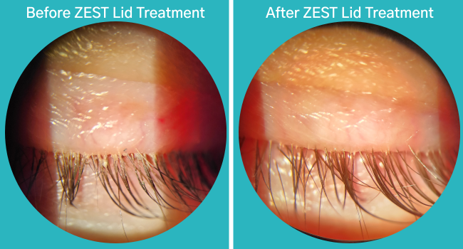 Two pictures of a person 's eye before and after zest lid treatment